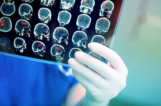 8 Quan Niệm Sai Lầm Về Đột Quỵ