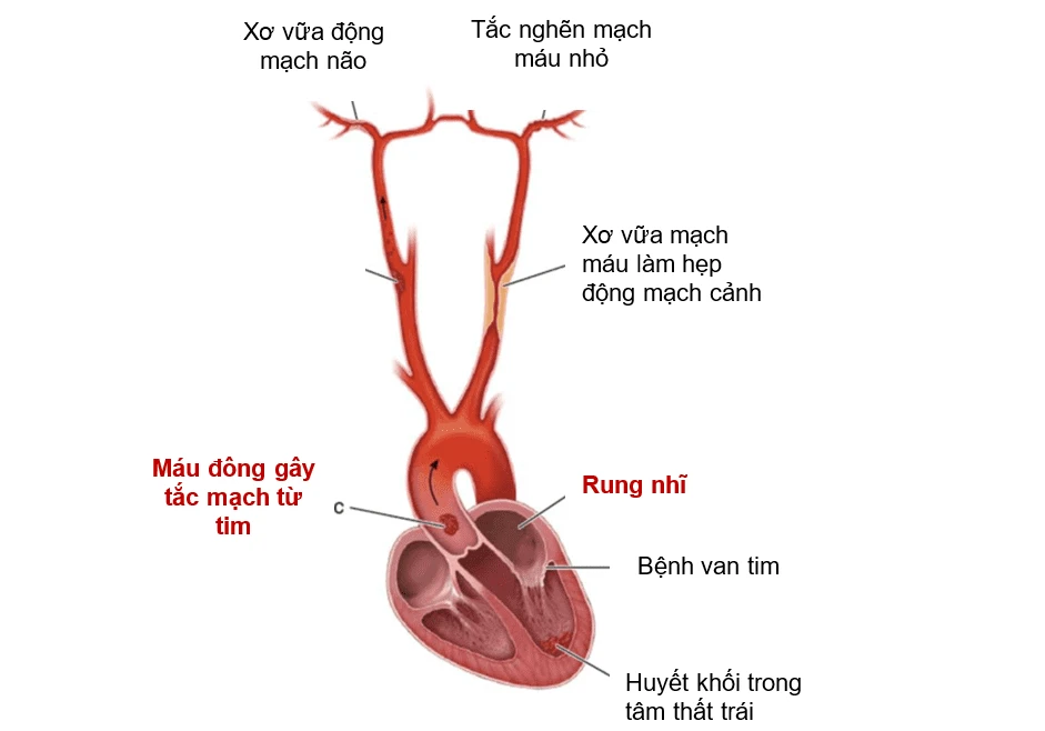 Bí Kíp Hóa Giải Đột Quỵ Do Rung Nhĩ, Ngăn Ngừa Hậu Quả Nặng Nề