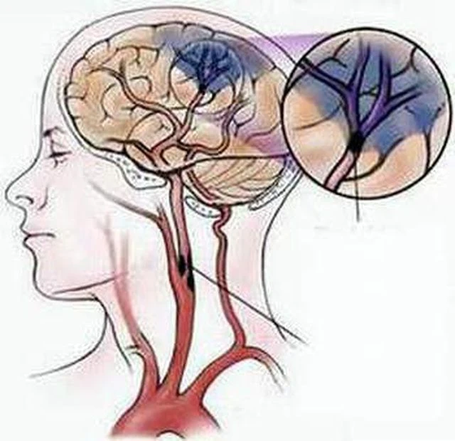 Cảnh giác đột quỵ ở người bệnh tiểu đường, huyết áp, rung nhĩ