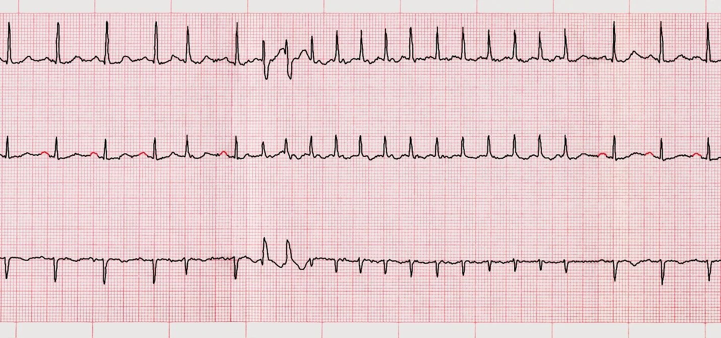 Chuẩn Đoán Rung Nhĩ Và Nhận Biết Đột Quỵ Thiếu Máu Não Như Thế Nào?