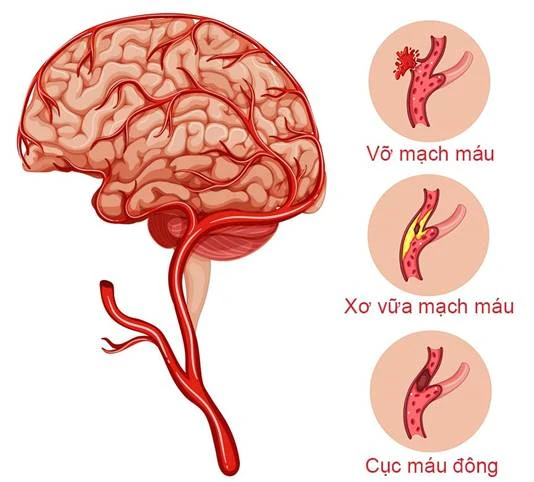 Dấu Hiệu Nhận Biết Đột Quỵ
