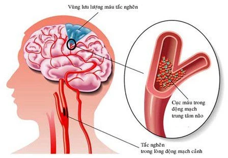 Phòng Ngừa Đột Quỵ Do Xơ Vữa Động Mạch