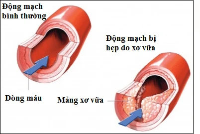 Phòng Ngừa Đột Quỵ Do Xơ Vữa Động Mạch